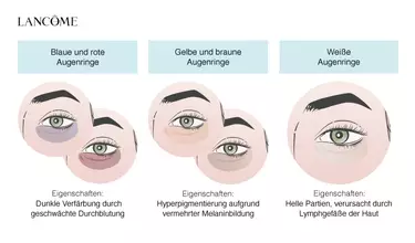 Grafik zeigt blaue, braune und weiße Augenringe und erklart ihre unterschiedlichen Entstehungsgrunde