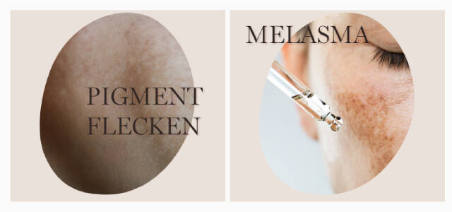 Pigmentflecken und Melasmen
