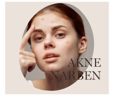 Akne Narben im Gesicht