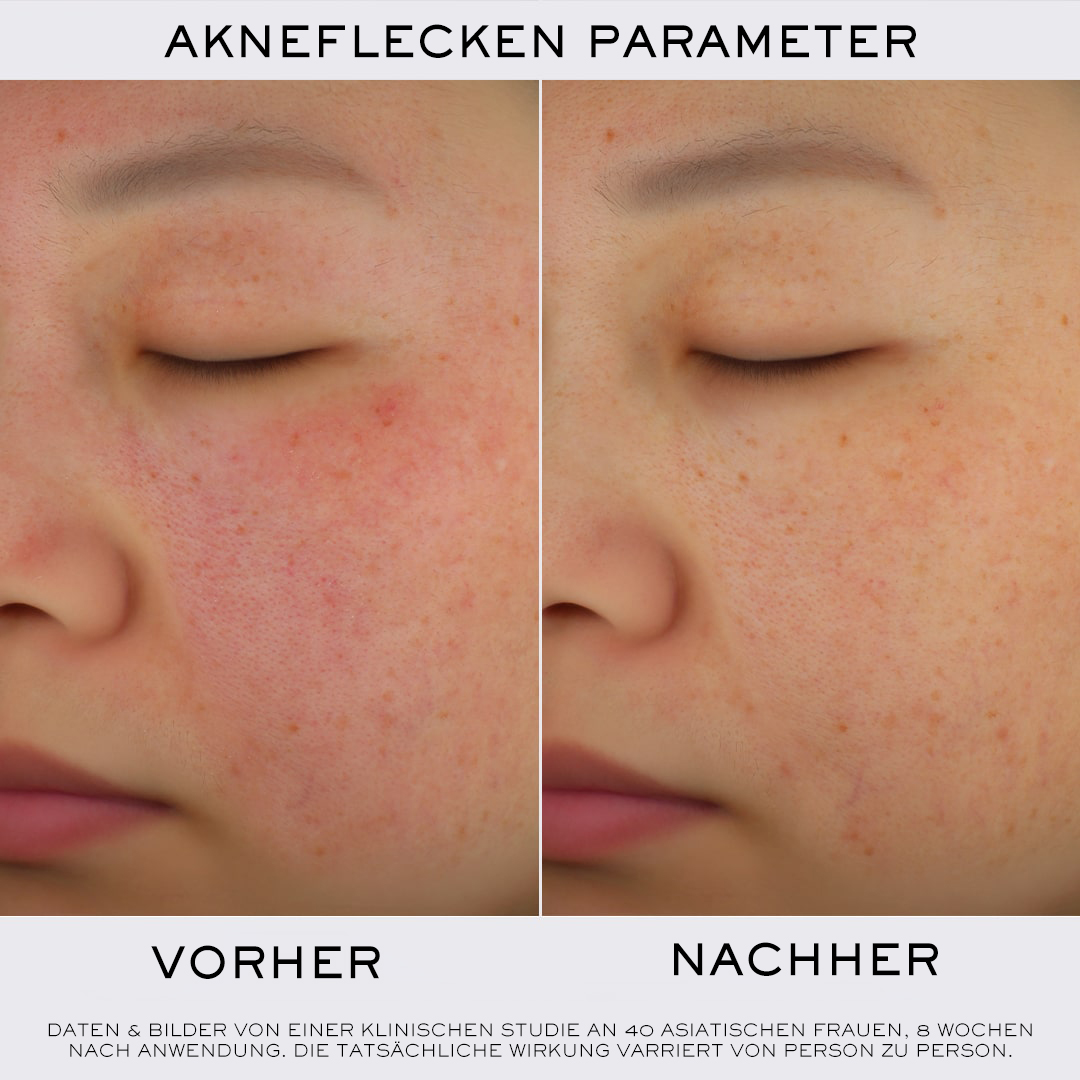 Vorher-Nachher-Vergleich der Haut einer asiatischen Frau mit Akneflecken nach 8 Wochen Behandlung.
